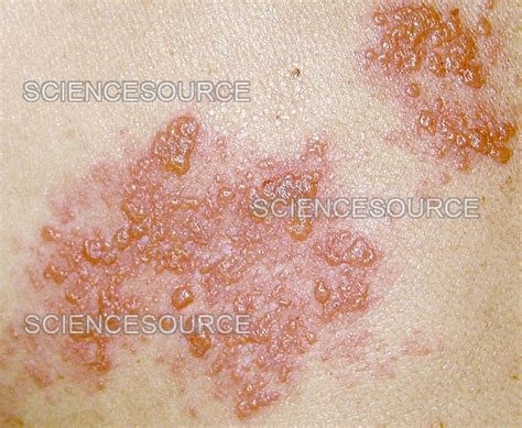 Herpes zoster rash | Stock Image - Science Source Images