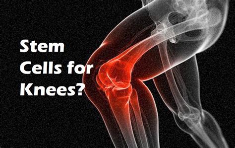 Stem Cells for Knees | CSC - Regenerative Orthopedics