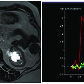 MRI perfusion images of non-tumorous pancreatic parenchymal tissue in ...