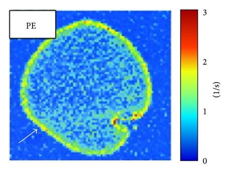 MRI of human plasma clots treated with fibrin targeted perfluorocarbon... | Download Scientific ...