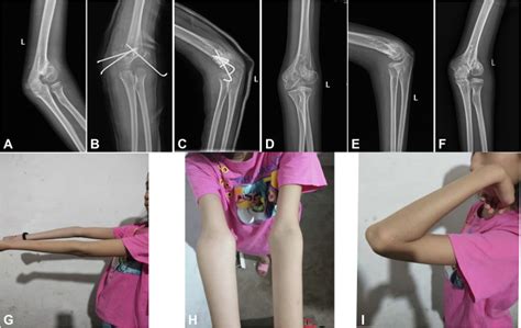 Trapezoidal Osteotomy for Treatment of Long-Standing Nonunion of ...