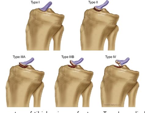 [PDF] Tibial eminence fractures. | Semantic Scholar