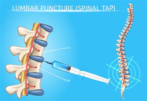Why Would A Newborn Baby Need A Lumbar Puncture at barbarajharris blog
