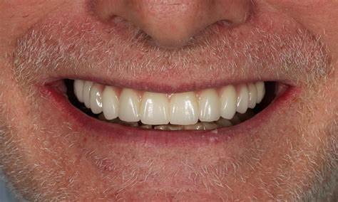 Restorative Dentistry Gallery | Layered zirconia reconstruction