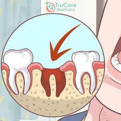 Painful Dry Sockets Post Tooth Extraction and How to Handle the Pain – TruCare Dentistry