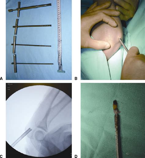 A Different-sized bone biopsy trephines. B Insertion of trephine via an... | Download Scientific ...