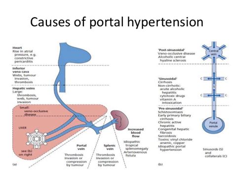 Portal Hypertension