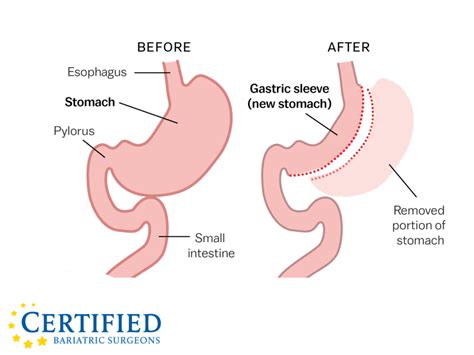 Gastric Sleeve Surgery | Certified Bariatric Surgeons