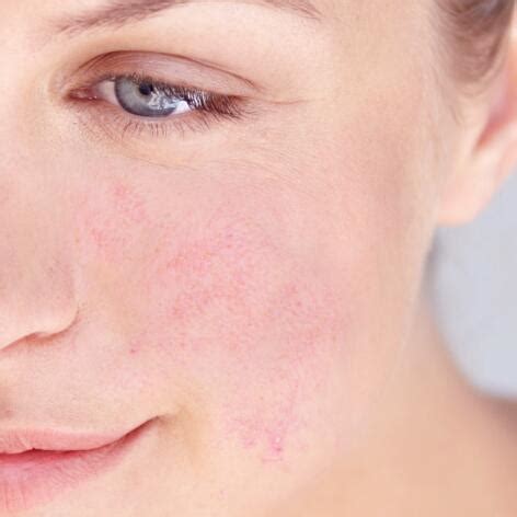 Erythrose visage : symptômes et traitements anti-rougeurs