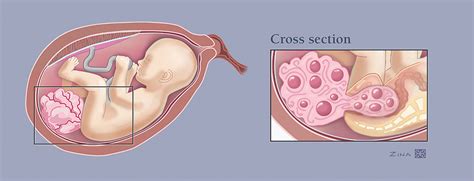 Sacrococcygeal_teratoma - Fetal Health Foundation