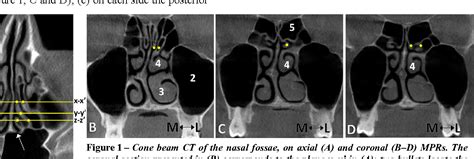 Variant anatomy of nasal turbinates: supreme, superior and middle conchae bullosae, paradoxical ...