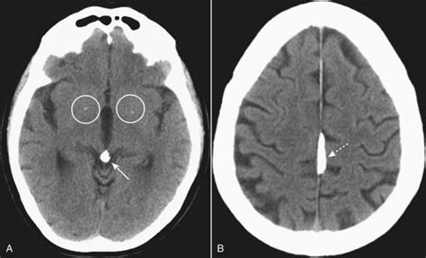 Recognizing Some Common Causes of Intracranial Pathology | Radiology Key