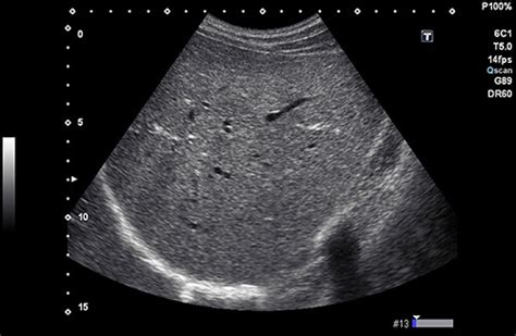 Ultrasound of Fatty Liver - Theayurveda