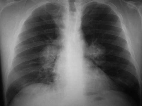 Bilateral hilar lymph node enlargement | Radiology Reference Article | Radiopaedia.org ...