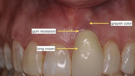 Receding Gum Tissue After Dental Implant Treatments | Receding Gum Tissue After Dental Implant ...