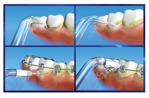 What is a water flosser? - Dr Chauvin