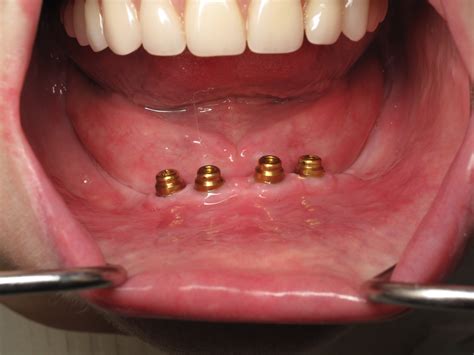 The Ultimate Guide to Keeping Your Snap-In Dentures Sparkling Clean – Norman's Blog