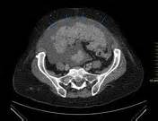 Peritoneal metastases | Radiology Reference Article | Radiopaedia.org