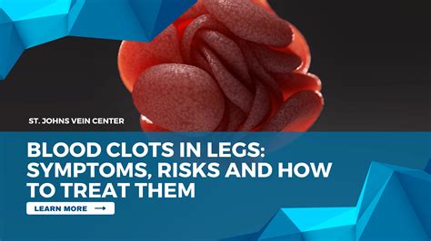 Blood Clots In Legs: Symptoms, Risks and How To Treat Them - St Johns ...