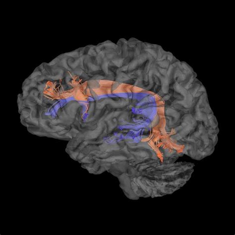 Trajectory and Termination of the Arcuate Fasciculus Segments on DTI ...