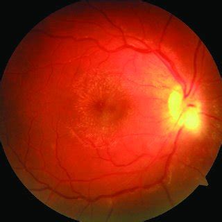 Optic nerve involvement secondary to distant active lesion. | Download ...