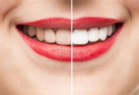 How to get whiter teeth: Four top tips to help achieve a brighter smile | The Independent