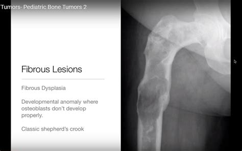 Radiology of Paediatric Bone Tumours Part 2 — OrthopaedicPrinciples.com