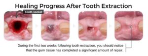 Tooth Extraction Aftercare (Instructions): The Dos & Don’ts