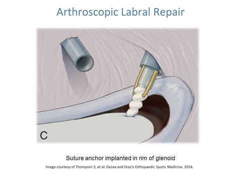 Shoulder Labral Tear- Labral Repair and Rehabilitation | Ashvin K Dewan, MD