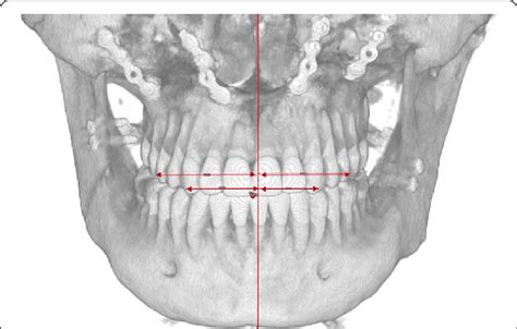 View of a frontal dento-alveolar analysis in a PostOp case | Download ...