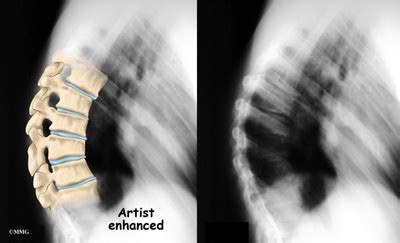 Scheuermann's Disease - eOrthopod.com