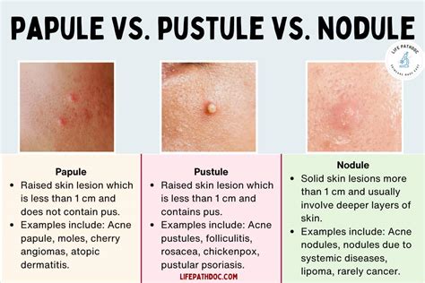 Papule vs Pustule vs Nodule: Pictures, Differences, and Causes