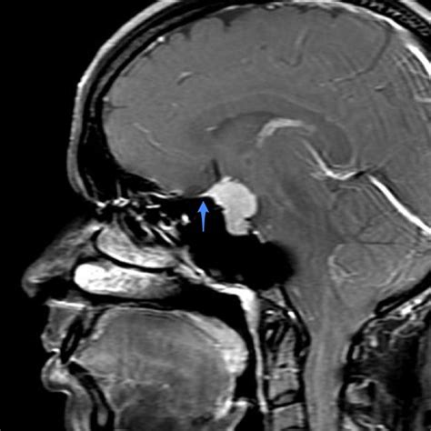 Diaphragma Sellae Mri