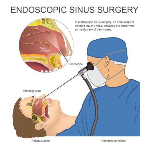 Functional Endoscopic Sinus Surgery - ENT Florida