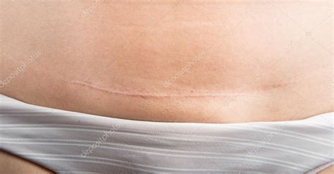 C section Cesarean operation heal after — Stock Photo © wckiw #76278151