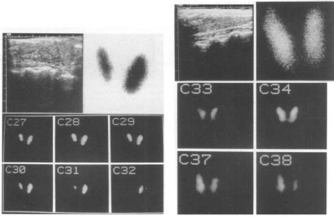 Patient MC with multinodular goitre: ultrasound (a) shows small nodules... | Download Scientific ...