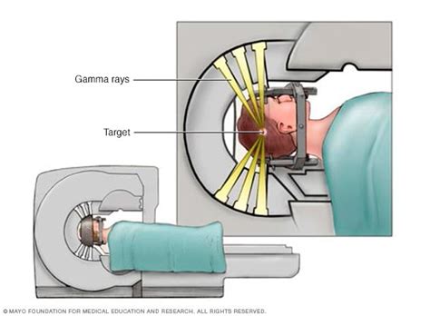 Stereotactic radiosurgery - Mayo Clinic