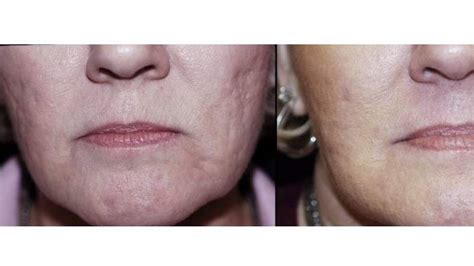 Boxcar Acne Scars Treatment - Gainesville Florida