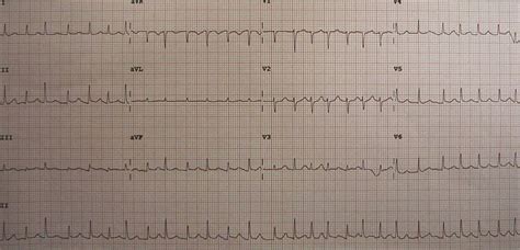 Electrical alternans - wikidoc