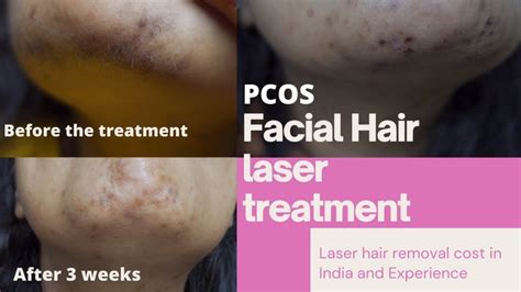 PCOS Facial hair laser treatment before and after | Laser hair removal ...