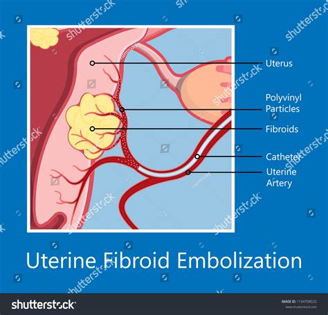 39 Uterine Fibroid Embolization Images, Stock Photos & Vectors | Shutterstock