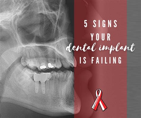 5 signs dental implant is failing - Fight Gum Disease