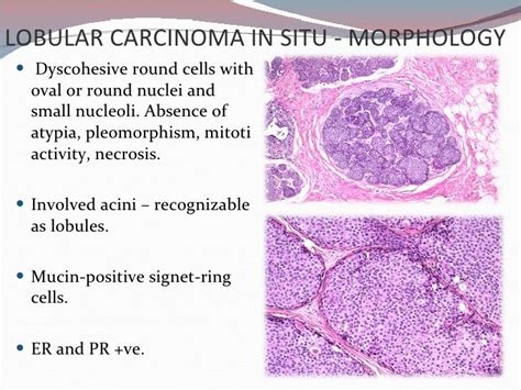 Pin op "Lobular carcinoma"