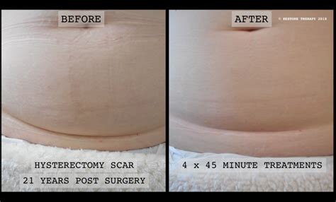 hysterectomy scar before and after | Restore Therapy