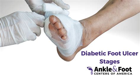 Diabetic Foot Ulcer Treatment & Prevention - What to Know!