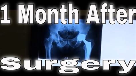 My Total Hip Replacement Surgery & Recovery ... 1 Month After ... - YouTube