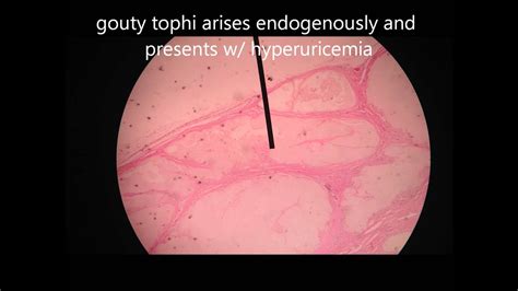 Gouty Tophi histology - YouTube