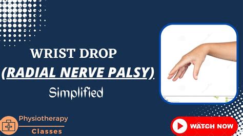 Wrist drop | wrist drop anatomy | wrist drop nerve - YouTube