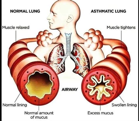 Normal lung vs Asthmatic lung - MEDizzy