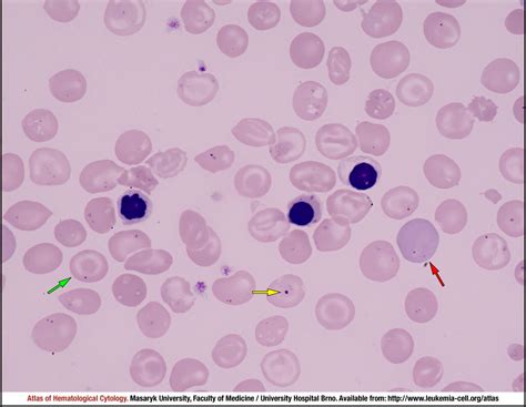 Beta thalassaemia major - CELL - Atlas of Haematological Cytology